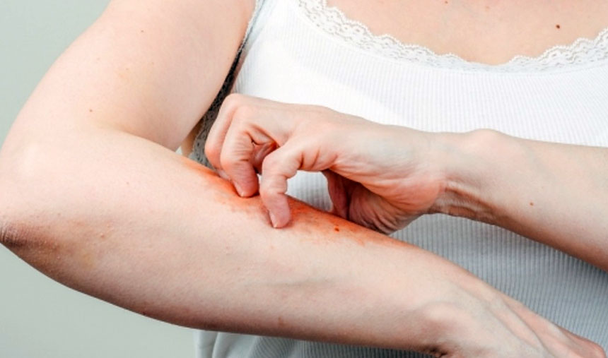 psoriase