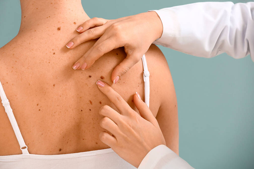 5 mitos sobre como se proteger do câncer de pele